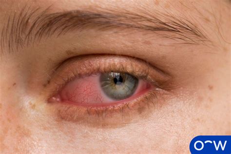 Shingles Inside Eye