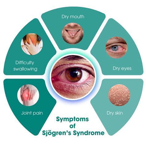 Sjögren's Syndrome Management: Expert Tips