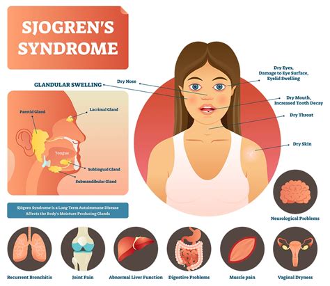Sjögren's Syndrome Selfcare
