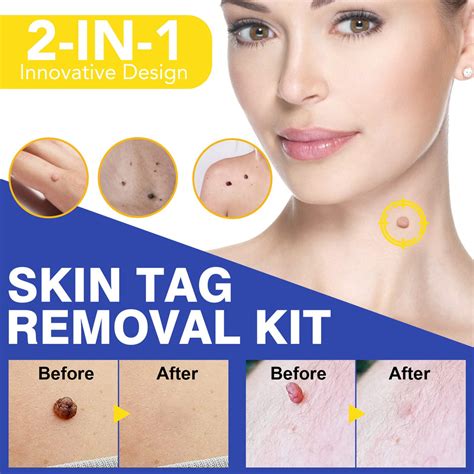 Skin Tag Removal Price