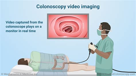 Slide Show What Happens During And After A Colonoscopy Slide Show What Happens During And After A Colonoscopy