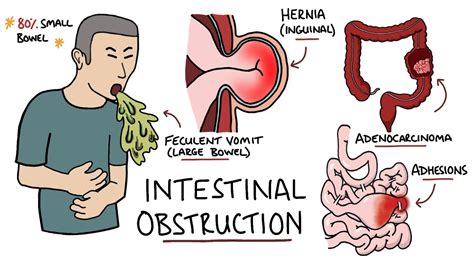 Small Bowel Obstruction Symptoms
