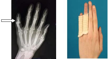 Small Finger Dislocation