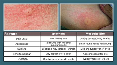 Spider Bite Vs Mosquito Bite Difference And Comparison
