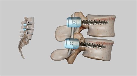 Spinal Fusion Surgery: Relieve Back Pain