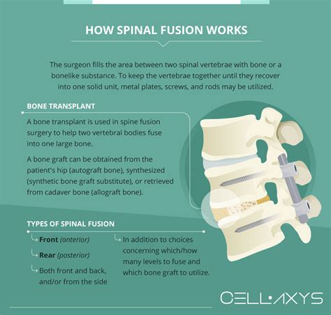 Spinal Fusion Surgery