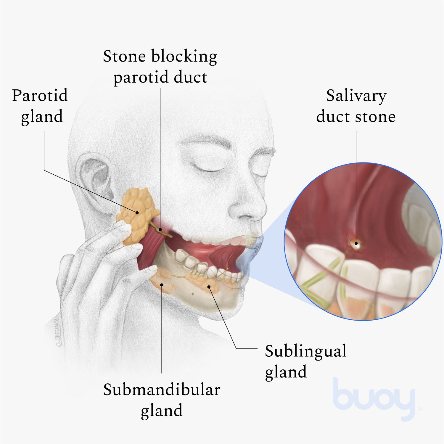Spit Gland Stone