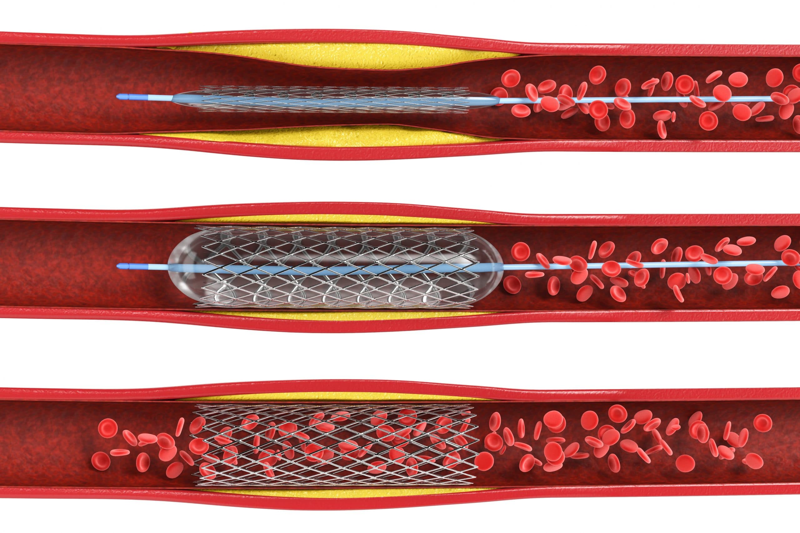Stent For Kidney Stones