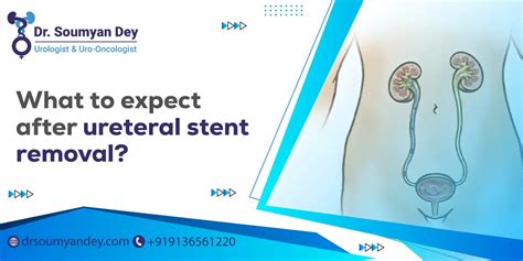 Stent Removal: Relieve Ureter Blockage