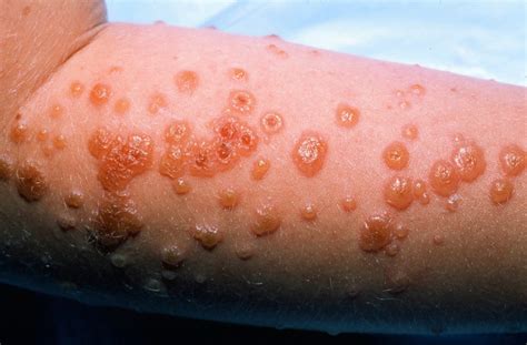 Stevens Johnson Syndrome