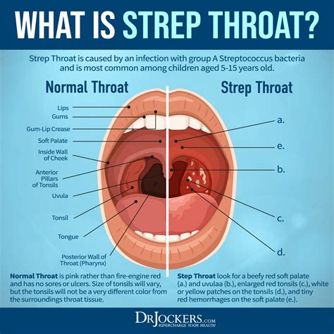 Strep Throat: Know The Symptoms