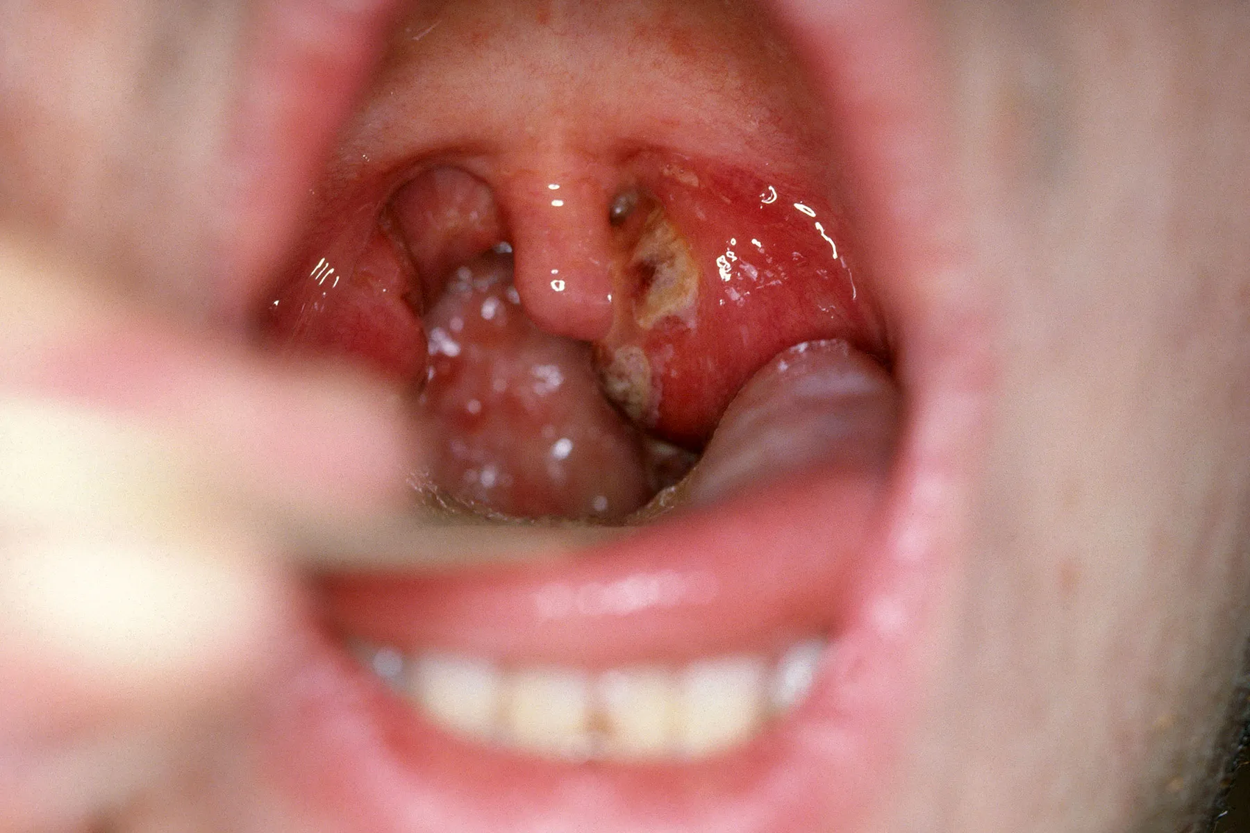 Strep Throat Pic: Identify & Heal Faster