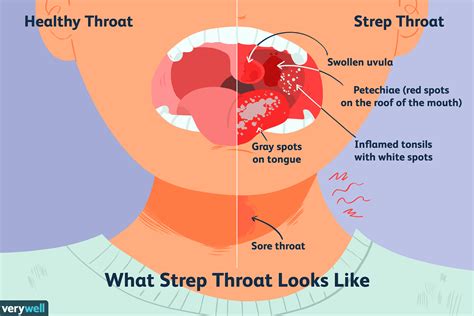 Strep Throat: Symptoms & Treatment