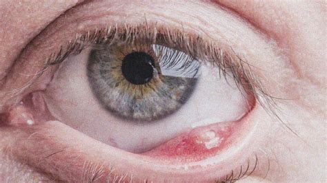 Stye Inside Eyelid Internal Stye How To Identify And Treatments Stye Inside Eyelid Internal Stye How To Identify And Treatments