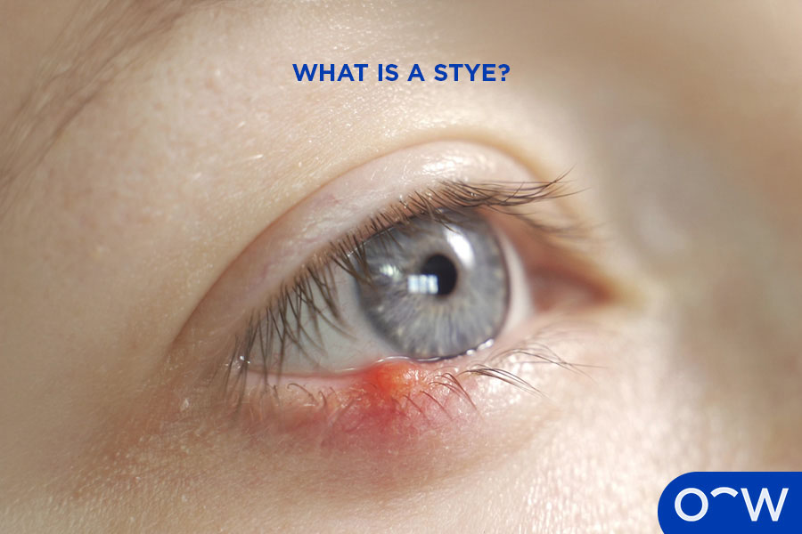 Stye Over The Counter Meds