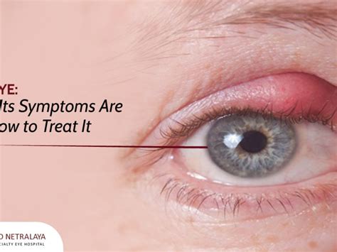Stye Treatment: How To Get Rid Of A Stye, 46% Off Stye Treatment: How To Get Rid Of A Stye, 46% Off