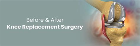 Surgery Before After Total Knee Replacement Spire Ortho
