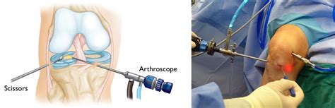 Surgery Of Meniscus Tear