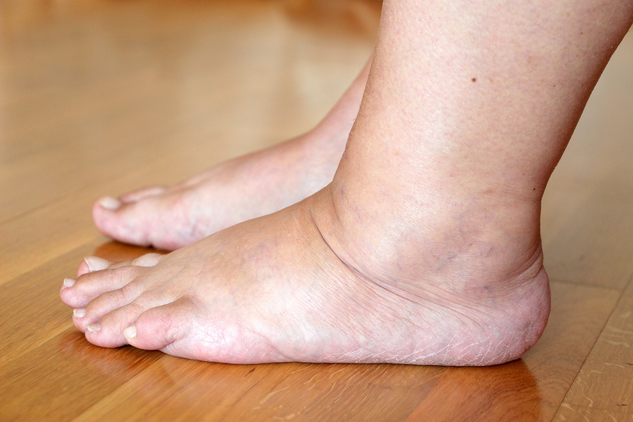 Swelling During Pregnancy