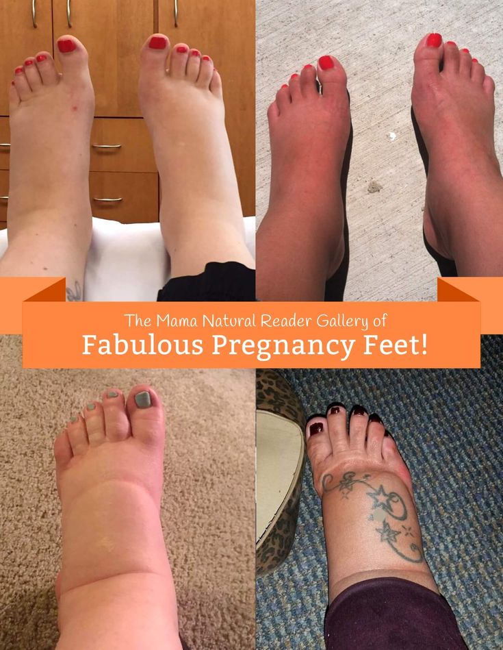 Swollen Feet During Pregnancy