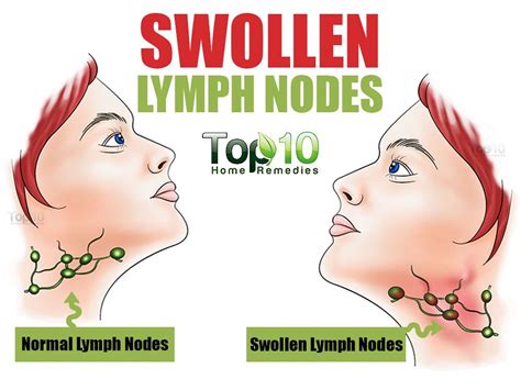 Swollen Lymph Node Under Jaw