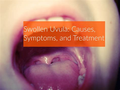 Swollen Uvula Causes And Symptoms Youtube