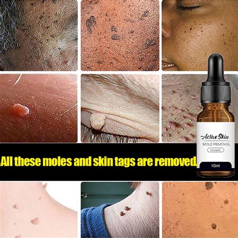 Tag Moles Removal