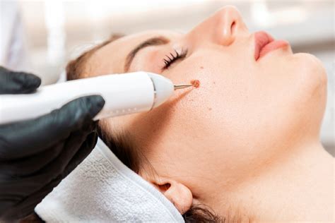 Tags Moles Removal Guide