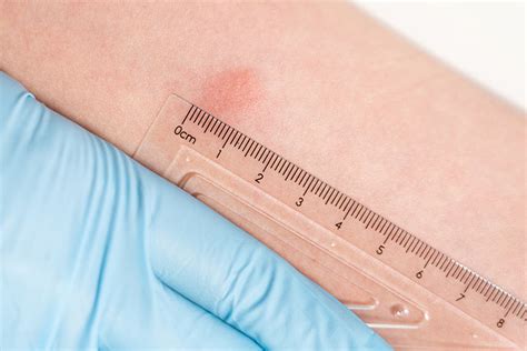 Tb Test Results