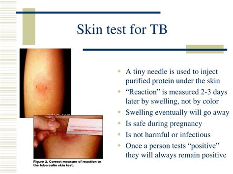 Tb Test Side Effects