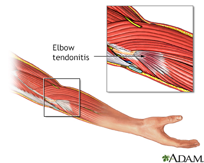 Tendinitis Of Wrist