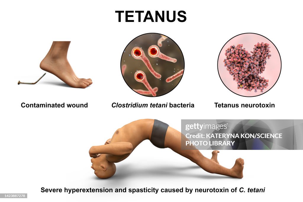 Tetanus Shot Schedule