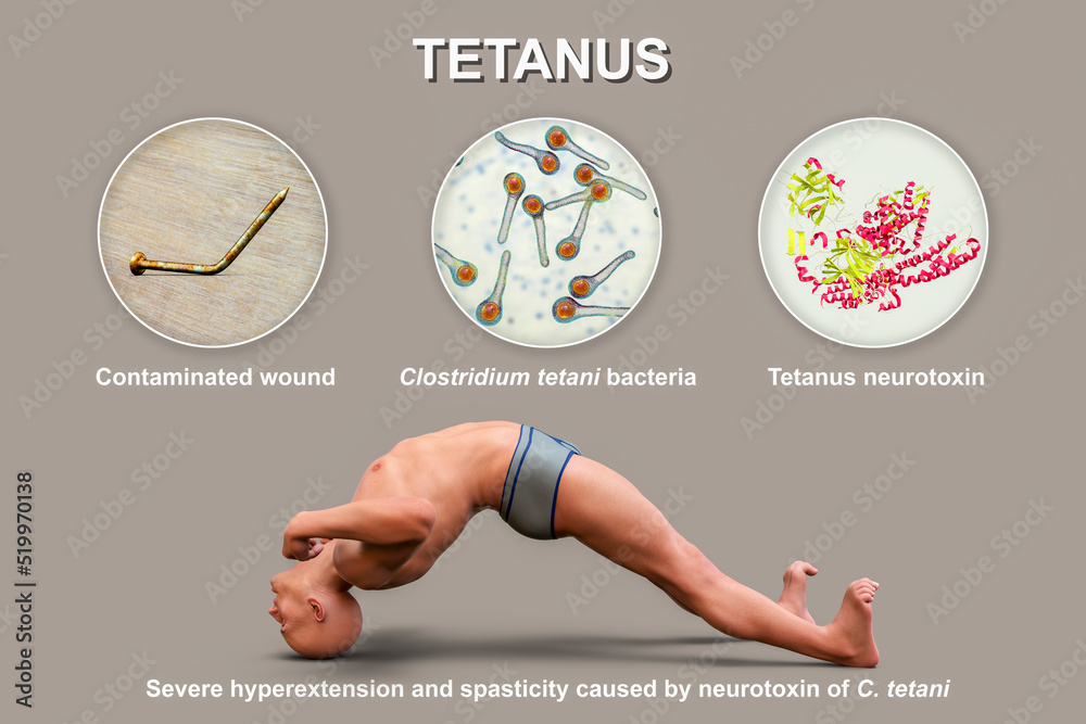 Tetanus Shots: Minimizing Pain