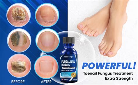 Ti Tree Oil: Fights Nail Fungus Infection Fast