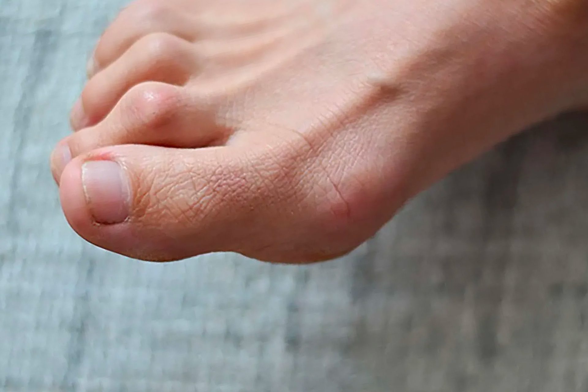 Toe Blister Treatment