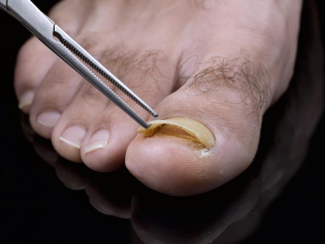 Toenail Falling Off Learn Best Treatment And Causes Toenail Falling Off Learn Best Treatment And Causes