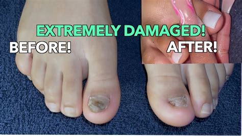 Toenail Ripped Off: Emergency Care Tips