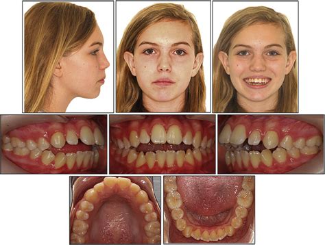 Tongue Bite Treatment