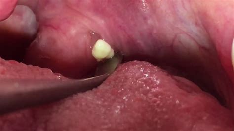 Tonsil Stone Removal