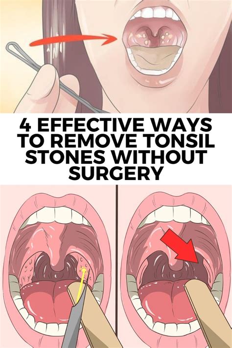 Tonsil Stones Removal: Easy Extraction Methods