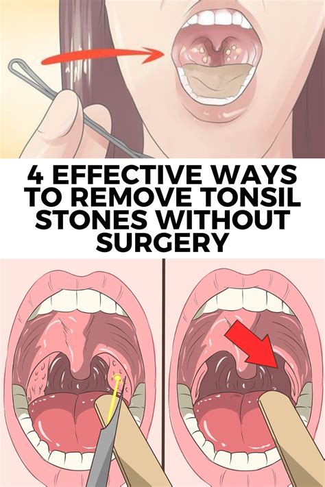 Tonsil Stones Specialists: Expert Removal