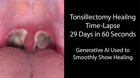 Tonsil Surgery Recovery