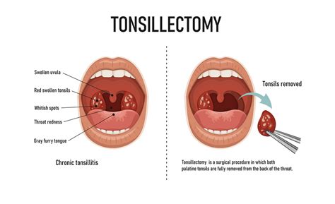 Tonsillectomy What You Need To Know