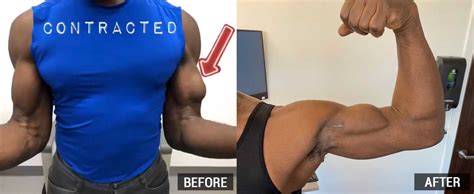 Torn Bicep Recovery