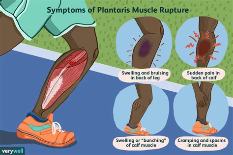 Torn Calf Muscle Symptoms: Fast Recovery Guide