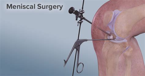 Torn Meniscus Operation