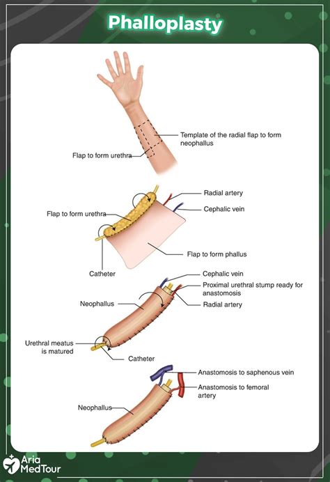 Transgender Penis Surgery: Expert Transformation Solutions