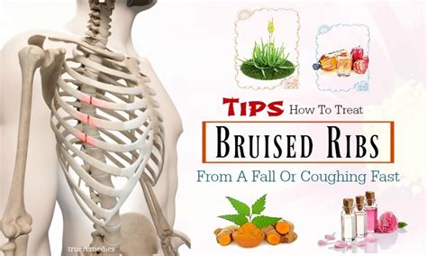 Treatment For Bruised Ribs