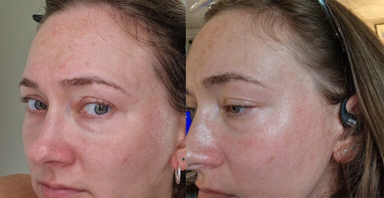 Tretinoin Cream 0.05