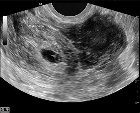 Tubal Ectopic Pregnancy